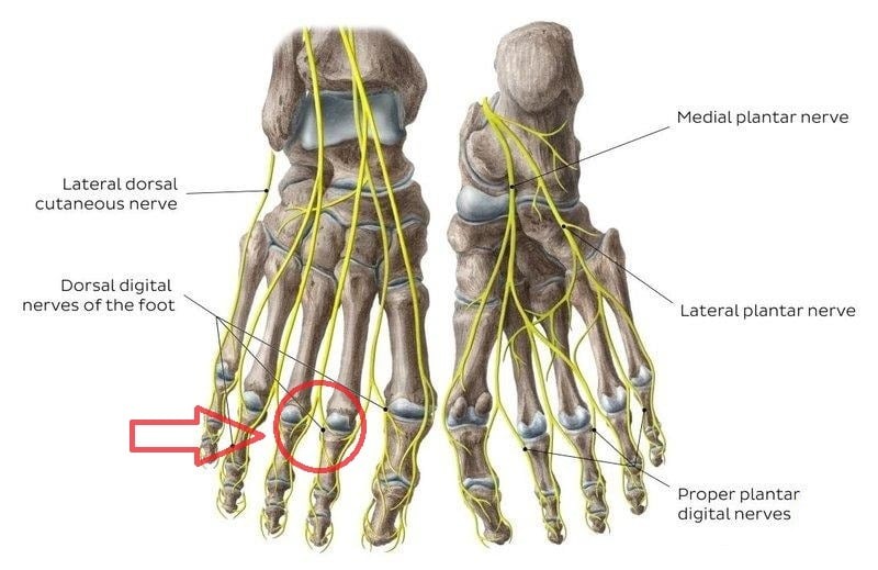 Neuralgia Mortona